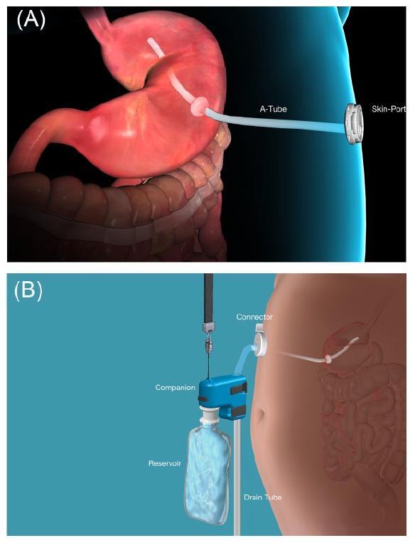 Aspiration Therapy (AT) Endoscopically placed gastrostomy tube siphon assembly allows for aspiration of gastric contents 20 minutes post-meal Instill 150-200 ml of water and repeat until no food