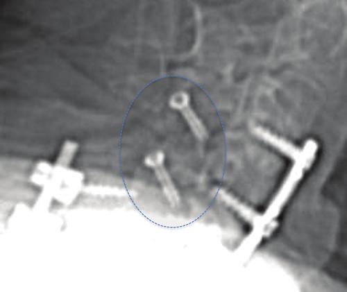 Percutaneous versus open transfacet fixation Fig. 1. Radiograph showing transfacet screws (dotted circle) augmenting the anterior cervical fusion. Figure is available in color online only. Fig. 2.