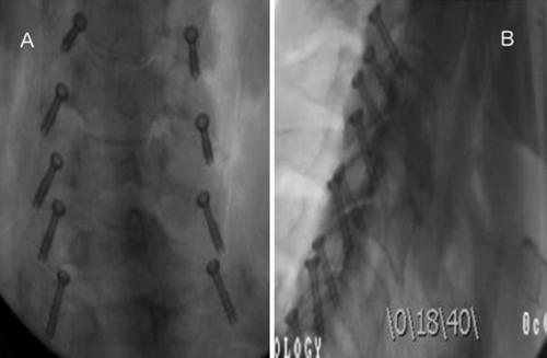 Anteroposterior and lateral fluoroscopic images were obtained for each level again, as was done with the percutaneous technique, to ensure accurate placement of the wires.