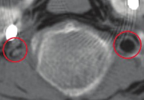 Percutaneous versus open transfacet fixation Fig. 6. Breach (circle) of the foramen transversarium with the percutaneous technique. Figure is available in color online only.