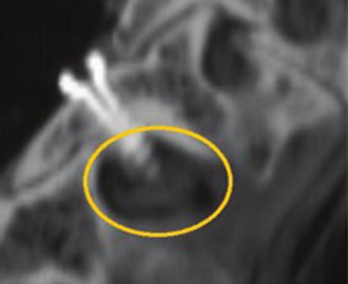 14 Ideal facet capture was at the midpoint-midpoint position on the axial and sagittal images at facet articulation.
