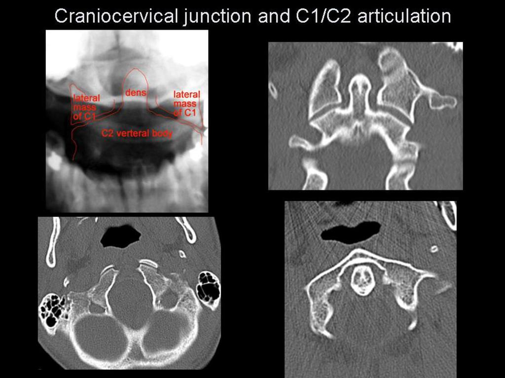 Fig. 0: Cranicervical junction