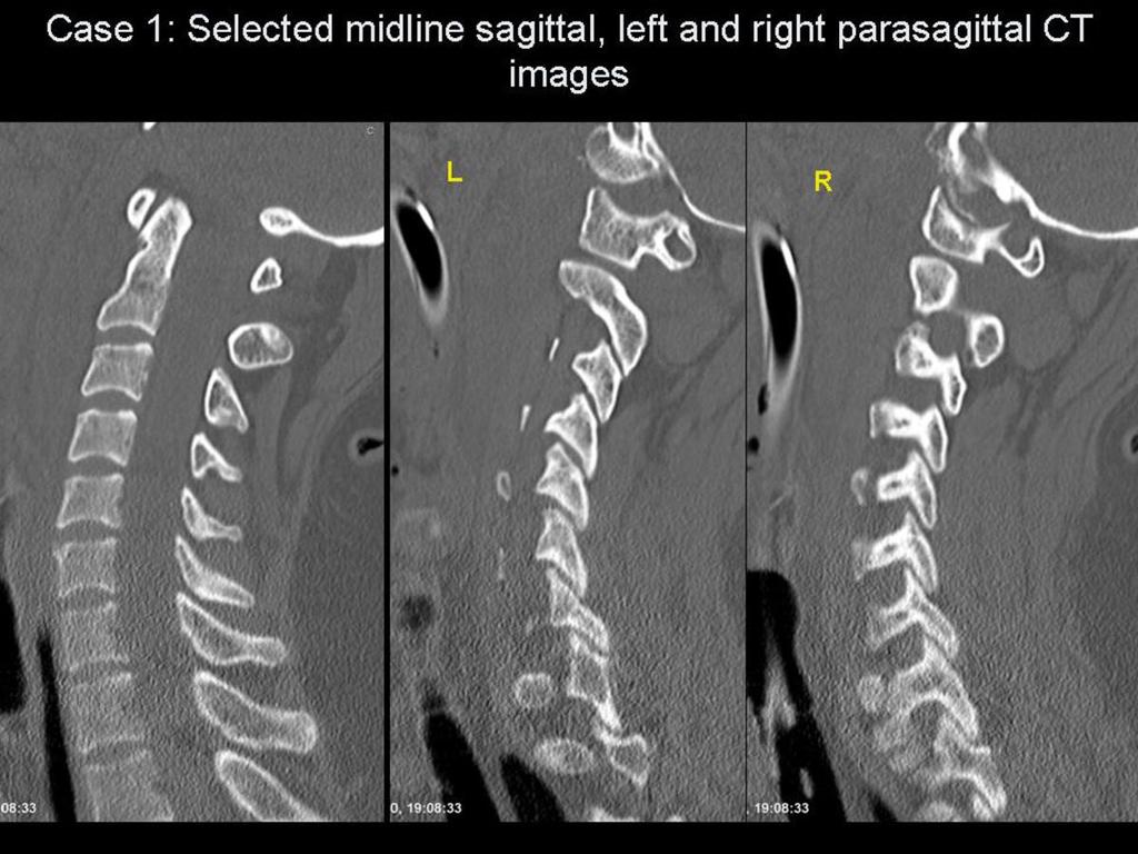 Imaging findings OR Procedure details Interactive Cases Case 1 43 year old male patient involved as a driver in a high speed road
