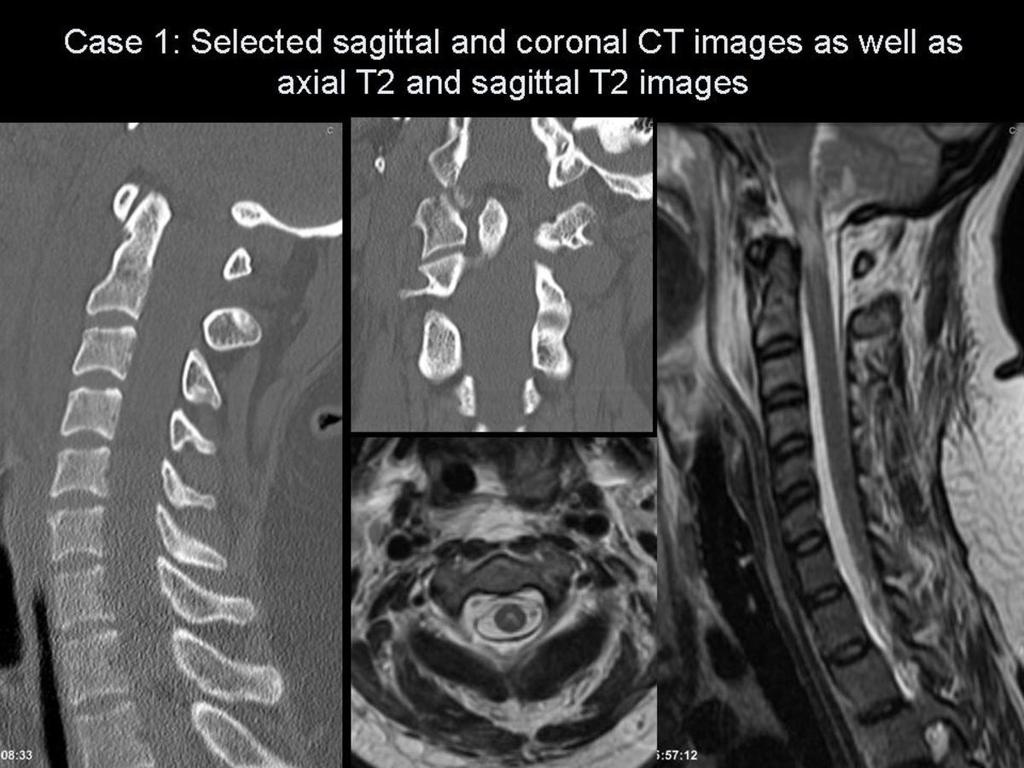 Fig.: Figure 8: Selected CT and MR images for case 1. The sagittal CT images reveal a craniocervical distraction injury (Figure 9).