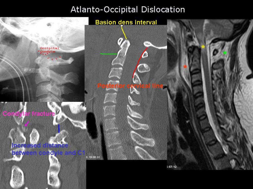 Fig.: Figure 9: Case 1 explained. Note the bone fragments (purple arrow) associated with disrupted occipitoatlanto joints representing fractures of the occipital condyles.