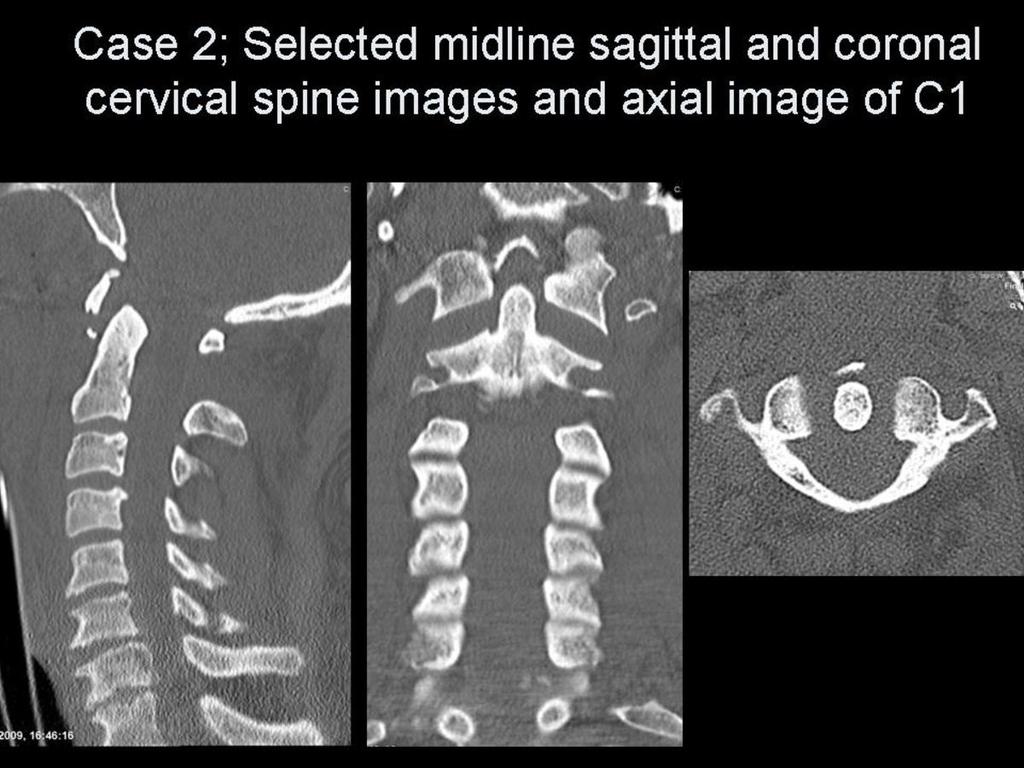 Atlanto-occipital dislocation usually results from high speed RTAs and represents <1% cervical spine injuries [5].