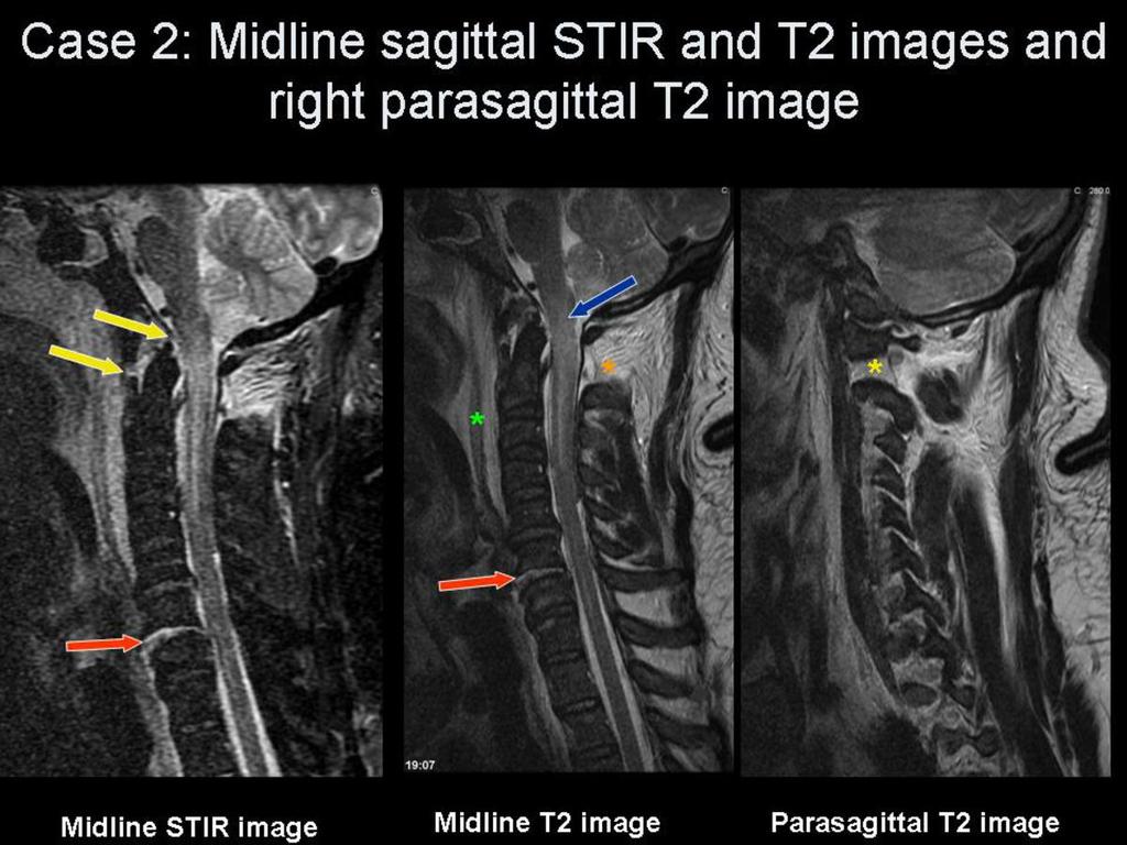 Fig.: Figure 10: Selected sagittal, coronal and axial images for case 2. Fig.: Figure 11: Selected sagittal images for case 2.