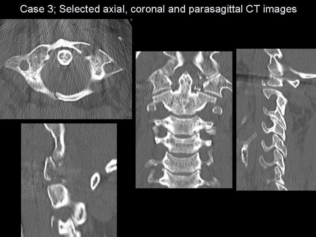 Fig.: Figure 12: Selected CT images for case 3. The CT images reveal a compression fracture of the C1 vertebra Jefferson Burst fracture.