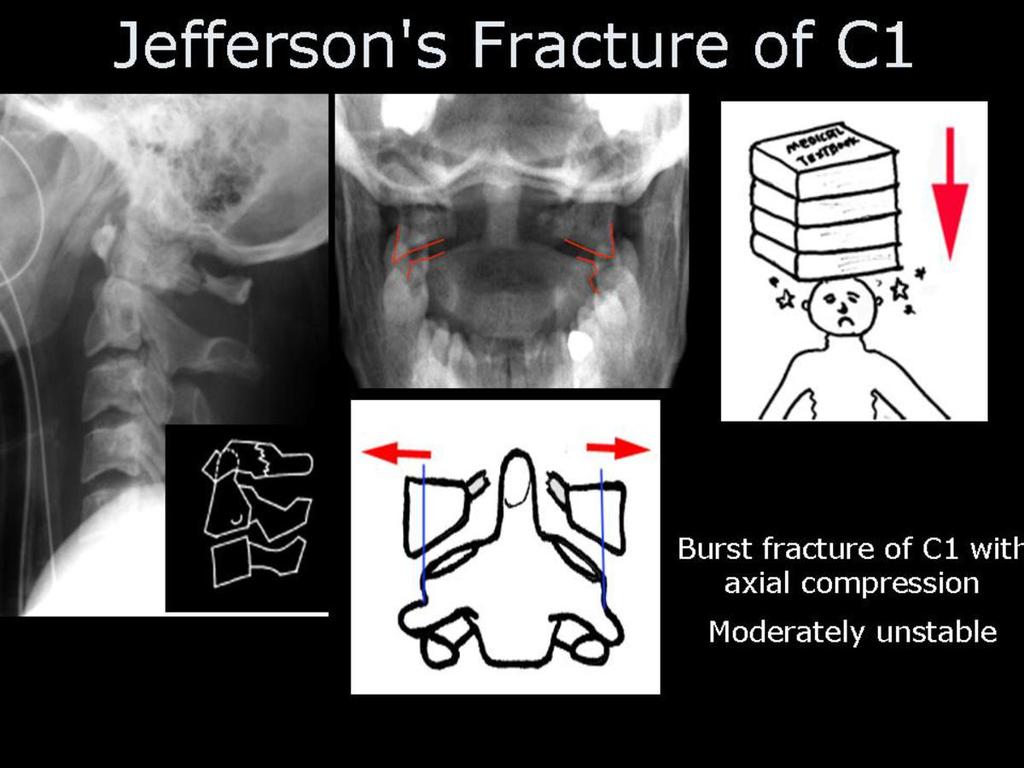 Fig.: Figure 13: Jefferson Burst fracture radiography. On CT imaging various patterns of arch disruption are identified.