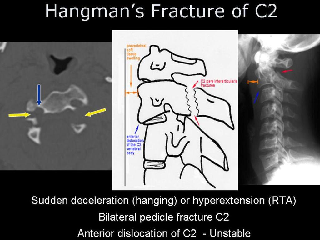 Fig.: Figure 15; Case 4 plain radiograph and CT explained. Different types of Hangman's fractures are described - also known as traumatic spondylisthesis of axis; Type I (65%); hairline fracture.