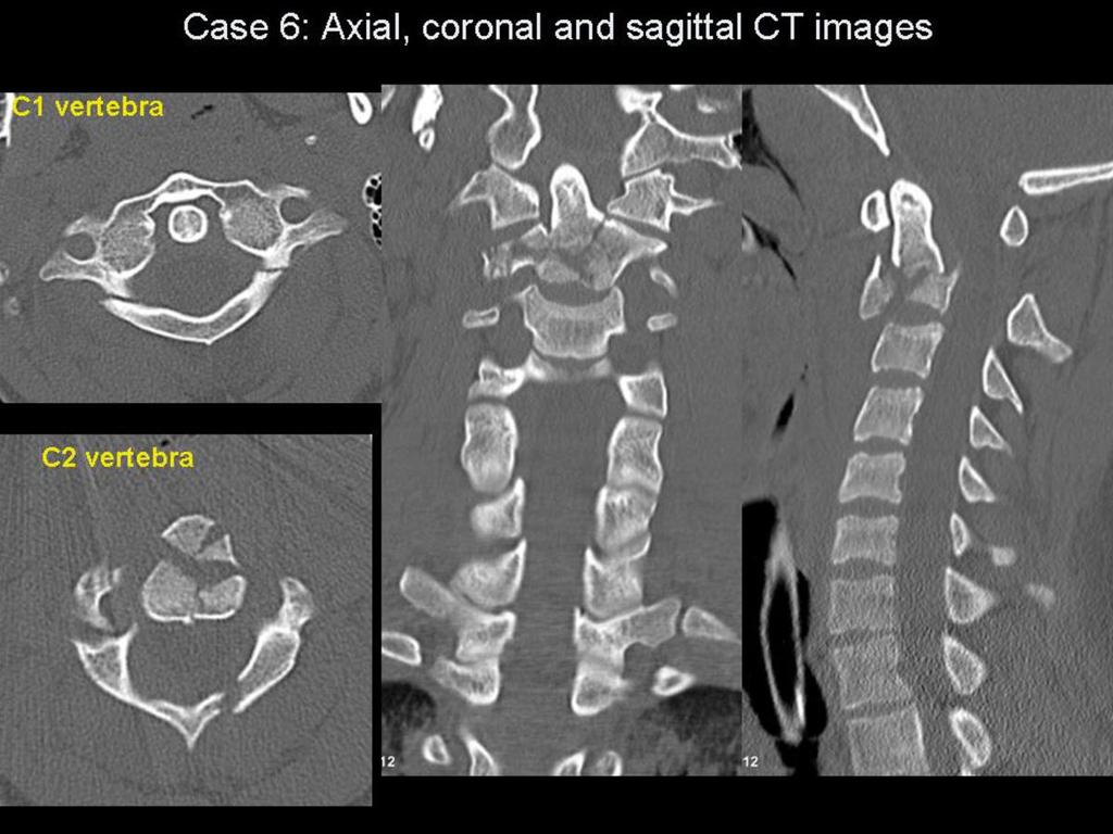 Fig.: Figure 18: Case 6 selected CT images. Axial loading compression force accounts for the pattern of injuries. Again note the burst fracture of C1 and associated prevertebral soft tissue swelling.