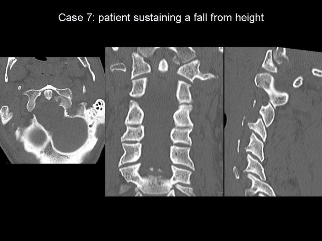 Fig.: Figure 20: Selected CT images for case 7 This is another example of a Type I occcipital condylar fracture resulting from a high-energy trauma.