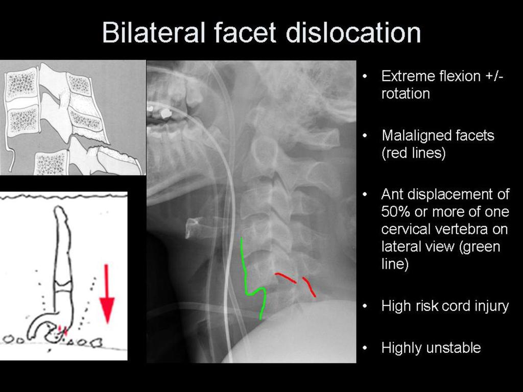 Fig.: Figure 23: plain radiography explained. The near-horizontal articulation of the cervical facets predisposes to easy subluxation once ligaments are torn.
