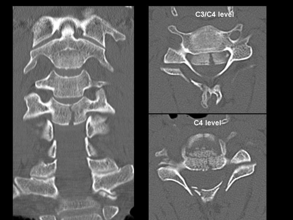 Fig.: Figure 25: further selected CT images. On the CT note the burst fracture of C4 with retropulsion and central canal compromise.