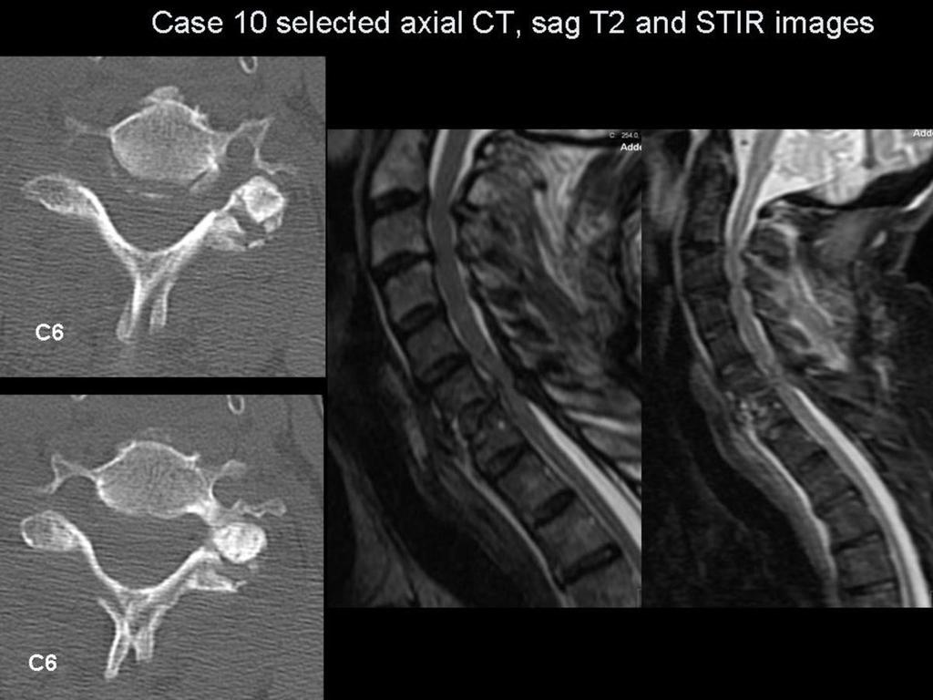 Fig.: Figure 27: selected CT and MR images for case 10. On the CT images note the anterior wedge compression fracture of the C7 vertebral body.