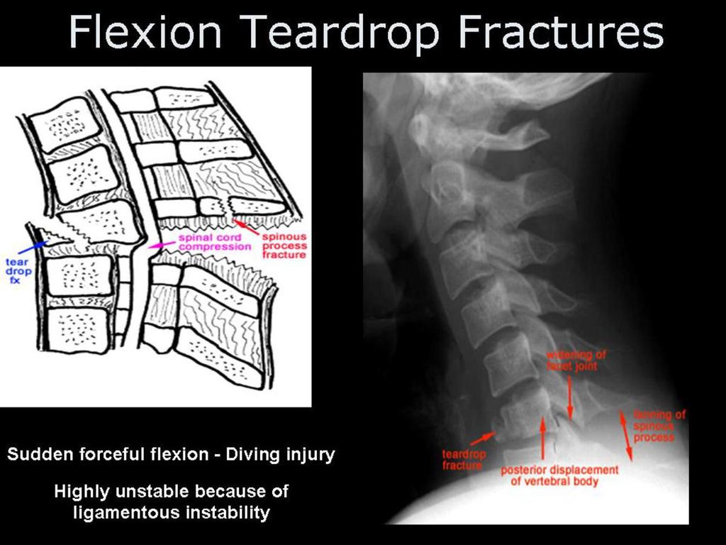 Fig.: Figure 28: flexion teardrop radiography.