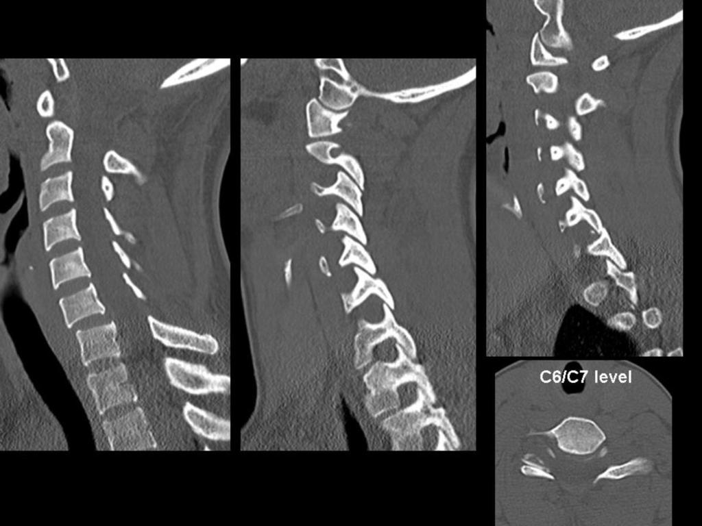 Fig.: Figure 30: case 11 selected CT images. On the AP radiograph note the abnormal alignment of the spinous processes at the C6 to C7 level.