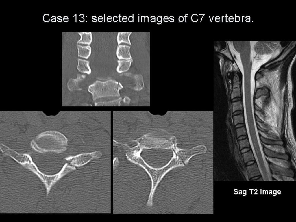 Fig.: Figure 33: case 13 selected CT and MR images. There is a comminuted fracture of C7 involving the left lateral mass that extends anteriorly into the vertebral body.
