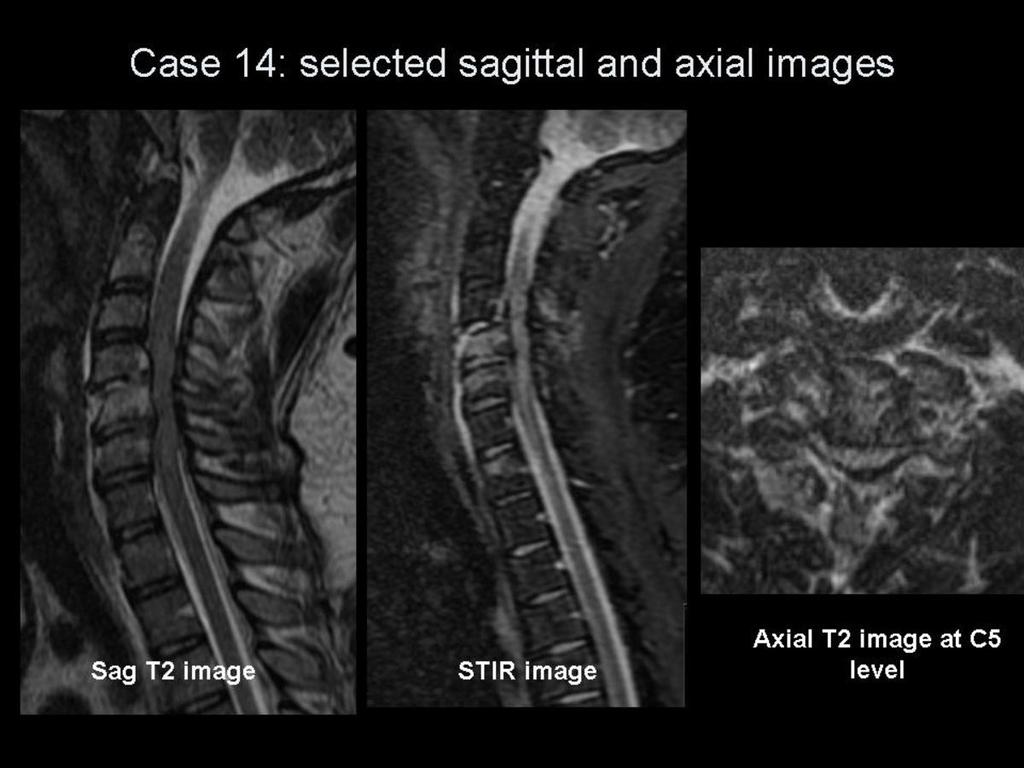 Fig.: Figure 35: case 14 selected MR images. On the CT images note the vertical fractures through the C4-C6 vertebral bodies with concomitant loss of anterior vertebral body height.