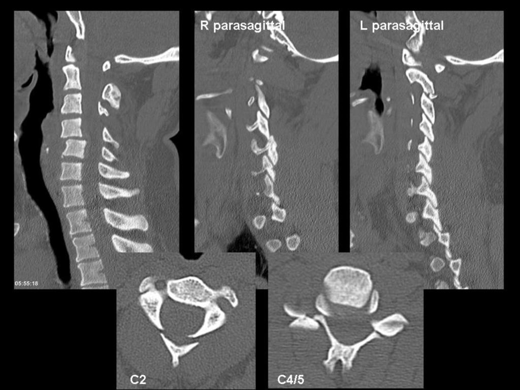 Case 15 34 year old male involved in a high speed RTA. Selected cervical spine images on Figures 36. Fig.: Figure 36: case 15 selected CT images. These images combine a number of different injuries.