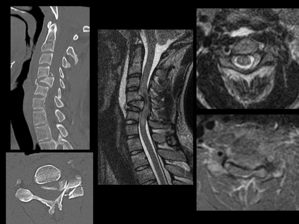 This trauma combined a number of injuries which suggest the mechanism involved a combination of rotation as well as significant Case 16 33 year old male involved in a high speed RTA.