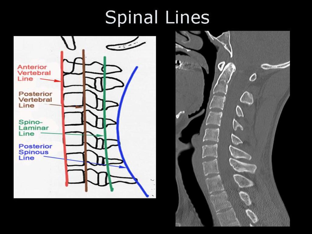 Fig. 0: Spinal lines applied to sagittal