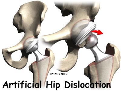 Rationale for Hip Precautions Why are precautions needed to prevent a hip dislocation? The joint capsule and ligaments keep the ball joint centered in the hip.