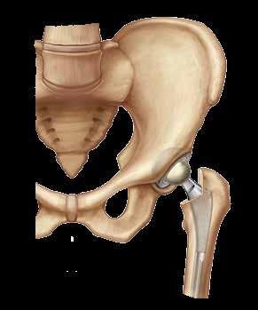 WHAT IS TOTAL HIP REPLACEMENT?