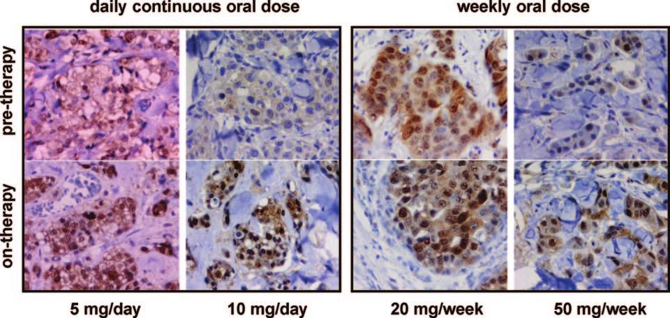 Baselga 17 Figure 5. The mtor inhibitor everolimus increases tumor pakt in breast cancer patients. From Tabernero J, Rojo F, Calvo E et al.