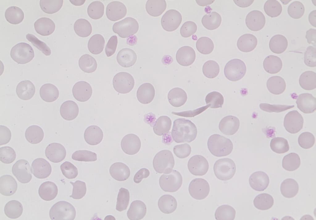 Erythrocyte case studies/ Anemia Sicklecells Diagnosis: Sicklecell anemia Case D13 The male teenager of African descent, living in Sweden with his parents, is followed for sicklecell anemia