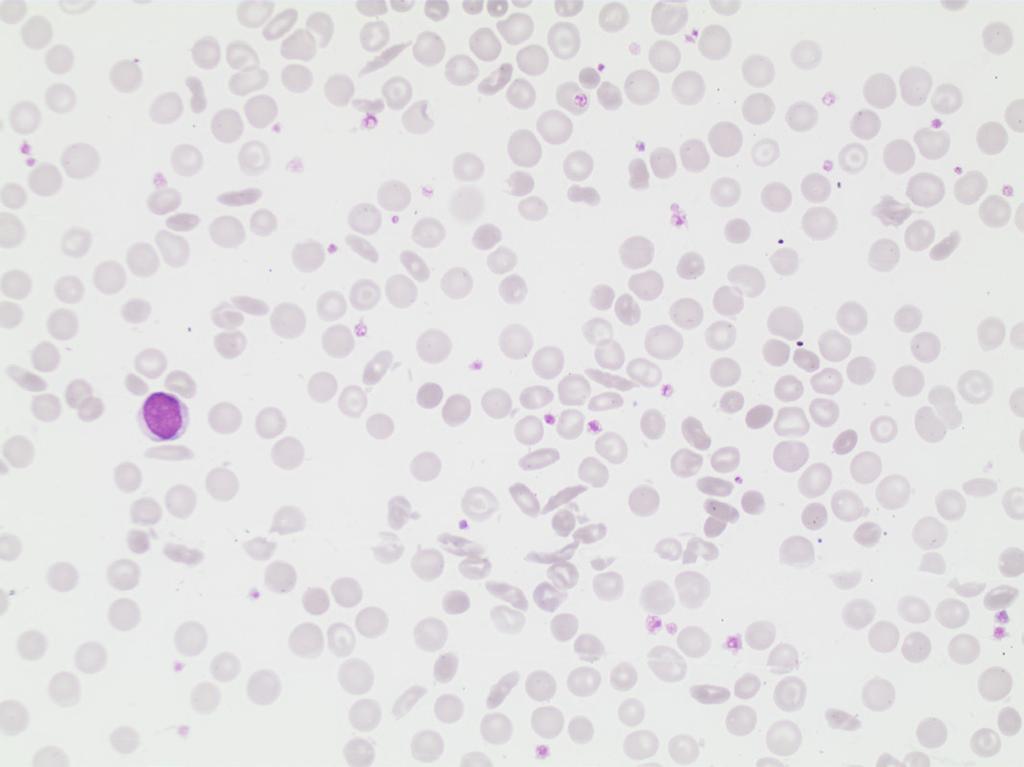 Erythrocyte case studies/ Anemia Sicklecells Diagnosis: Sicklecell anemia Case D15 A 29-year old man of African descent has sickle cell anemia (homozygote HbSS), and a daughter is also affected.