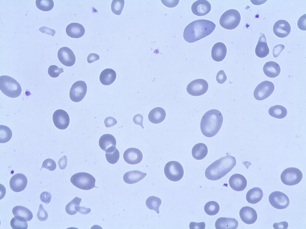Erythrocyte case studies/ Anemia Teardrop cells Case D17 Diagnosis: Megaloblastanemi This 37-year old man with an earlier history of alcohol overconsumption had a normal Hgb of 14,4 g/dl in 1999.