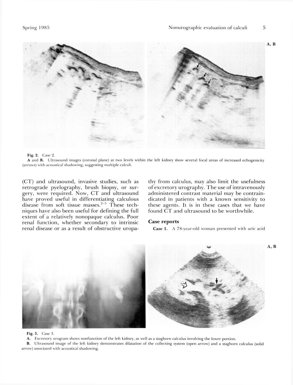 Spring 1 985 Nonurographic evaluation of calculi 5 Fig. 2. Case 2. A and B.