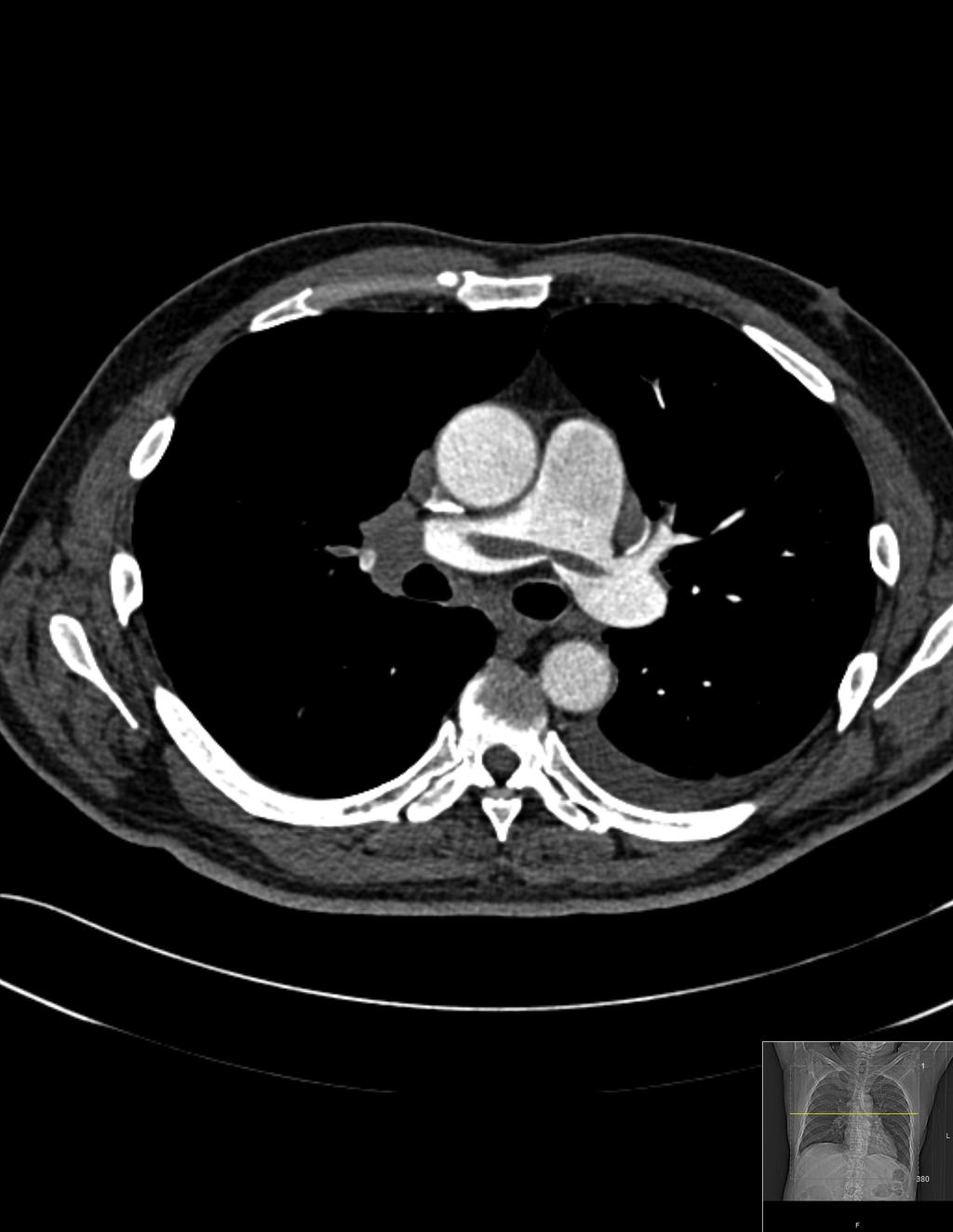 Case 3 CT pulmonary angiogram demonstrating saddle embolus, seen