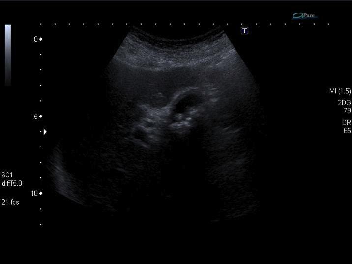 Discussion Ultrasound of acute cholecystitis with gallstones (red arrow)