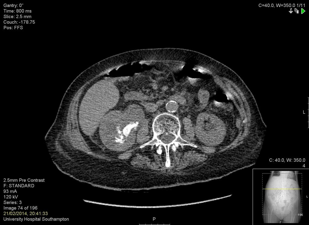 Case 1 CT KUB with renal pelvis and
