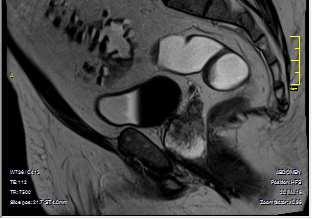 Left colonic divertikulitis-mri MRI findings is similar to CT: -bowel wall