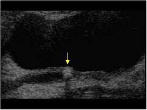 Lower ureteric, Vesico-Ureteric Junction stones-ultrasound Stones are visiblein the distal ureter at or near the UVJ, especially if