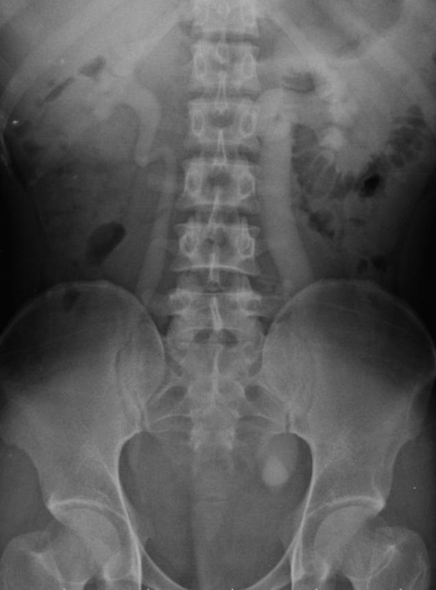 Lower ureteric, Vesico-Ureteric Junction stones-intravenous urography-ivu Provides physiological information related to the degree of obstruction The radiation dose is generally less than CT, but it