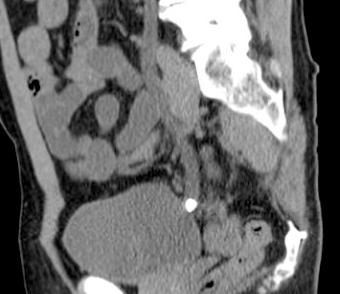 Lower ureteric, Vesico-Ureteric Junction stones-ct CT is the modality of choice in the evaluation of acut pelvic urolithiasis CT is faster and more effective in detection