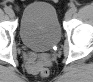 of 96-100% Low-dose CT protocol can be used as the initial imaging technique Disadvantages Stones at the UVJ may be difficult to distinguish from stones in the bladder