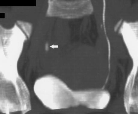 a phlebolith soft-tissue rim sign: favours a ureteric calculus CT urography (CTU or CT-IVU) gives both anatomical and functional information With intravenous contrast in a
