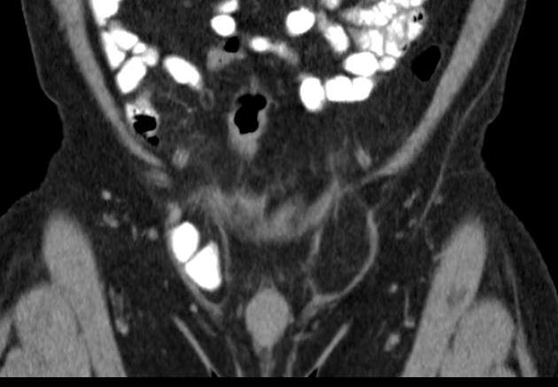 Inguinal hernia- Computed tomography Using CT scans, the sensitivity in 83%, specificity 67-83% Computed tomography (CT) remains the best available imaging tool for evaluation of