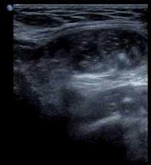 Inguinal hernia-ultrasonography Is useful in non-urgent,chronic cases Real-time examination allows to perform Valsalva or other maneuvers that elicit hernia symptom Visualization of peristalsis in