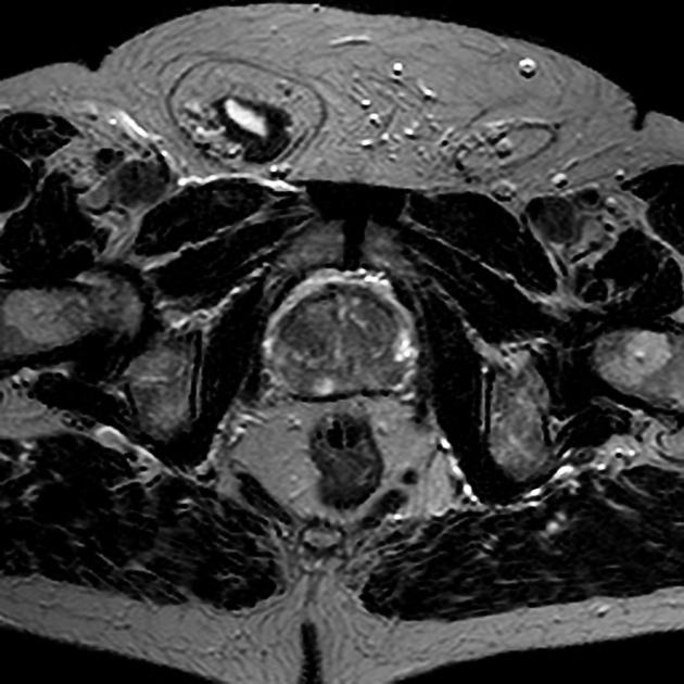 Generally is not a first-line imaging technique MRI allows for hernia evaluation in multiple imaging planes MRImay be useful in cases