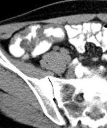 flegmone and abdominal abscesses CT enteroclysis in evaluation IBD of small bowel Sensitivity of CT