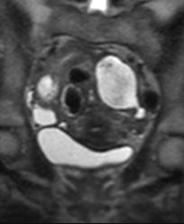 supralevator abscesses MRI is superior to CT in the