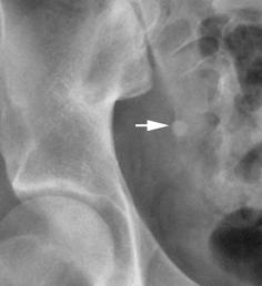 Appendicitis-Conventional radiography Plain radiographsare normal in many