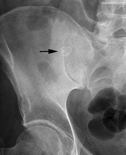 on plain radiographic films(in 10%) Barium enema For evaluation of chronic