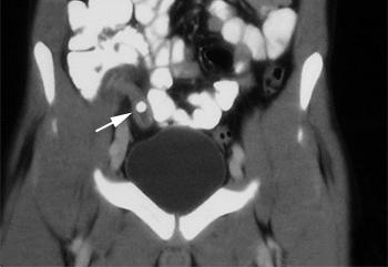 Appendicitis-Contrast-enhanced CT CT findings in chronic appendicitis are the same as those in acute appendicitis To evaluate adult